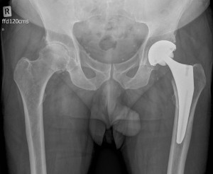 Post-operative x-ray demonstrating a total hip replacement in the same patient. 