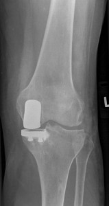 Partial (Unicompartmental) Knee Replacement | Mr Peter Misur